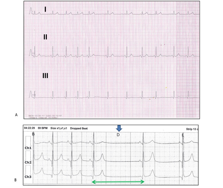 Rycina 4. Dziewczynka w wieku 13 lat, pływaczka. (A) EKG – w spoczynkowym zapisie nasilona niemiarowość zatokowa, rytm zatokowy 50-70/min. Przesuw papieru 25 mm/s. (B) Zapis holterowski EKG (3-kanałowy, Ch1 – zmodyfikowane komputerowo odprowadzenie przedsercowe V5, Ch2 – zmodyfikowane komputerowo odprowadzenie przedsercowe V1). W godzinach nocnych (godz. 04:22:29) zarejestrowano zahamowanie zatokowe (D – dropped beat; brak zarówno załamka P, jak i zespołu QRS – niebieska strzałka) z pauzą RR 2000 ms (zielona strzałka).