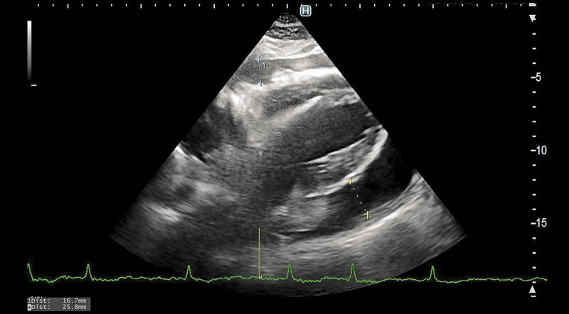 Rycina 3. Tamponada serca w przebiegu zapalenia osierdzia i przedawkowania acenokumarolu (INR = 13) u 75-letniej kobiety z zespołem zależności alkoholowej. Skuteczna perikardiocenteza chirurgiczna po wstępnym leczeniu farmakologicznym (leczenie przeciwzapalne, witamina K). Powiększona wątroba oraz lokalizacja płynu znacznie ograniczały możliwość perikardiocentezy przezskórnej