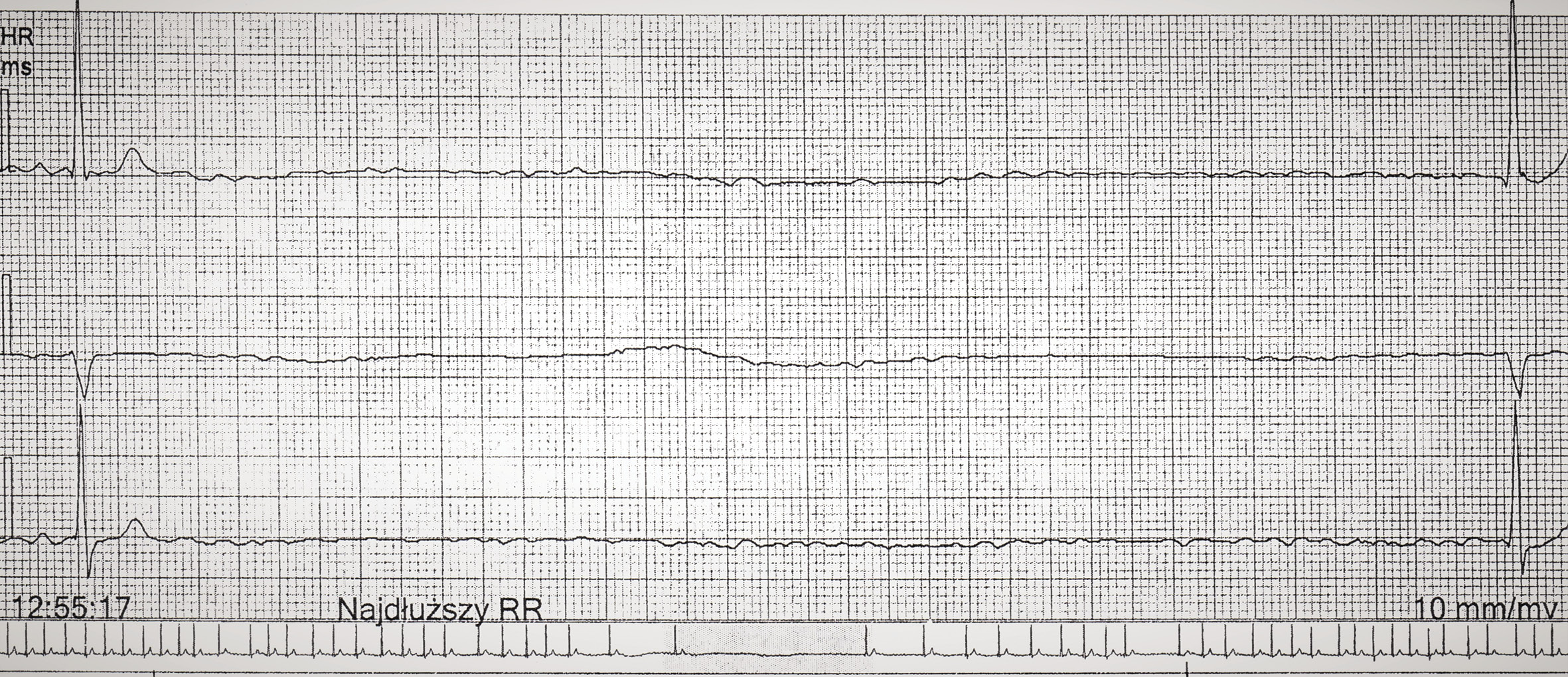 Rycina 1. Fragment zapisu z badania EKG metodą Holtera. Pauza trwająca 7138 ms zarejestrowana w trakcie snu u pacjenta z ciężkim obturacyjnym bezdechem sennym