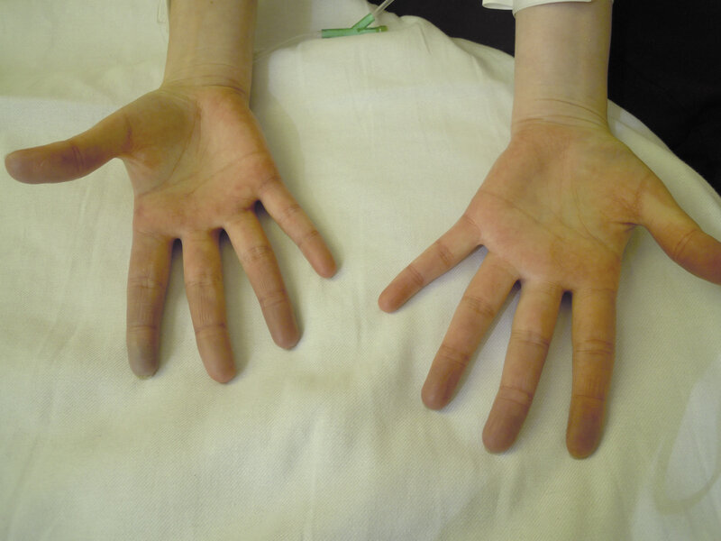 Objaw Raynauda - mieszana choroba tkanki łącznej.