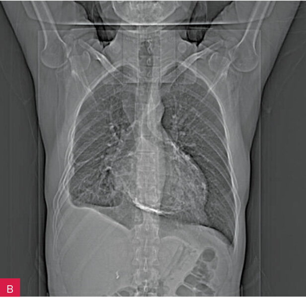 Rycina 5A i B. Badanie radiologiczne klatki piersiowej: zwapnienia w osierdziu