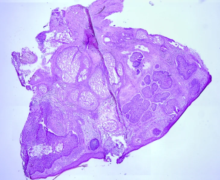 Rycina 3. Preparat histologiczny z biopsji, w którym wykazano (ponownie potwierdzono) obecność nacieków raka podstawnokomórkowego. Podobnie jak inne preparaty histologiczne jest to skan wykonany w programie PathoCam i odtwarzany z platformy PathoViewer firmy CancerCenter.ai przez upoważnionych użytkowników – niezależnie od ich fizycznej odległości od laboratorium histologicznego