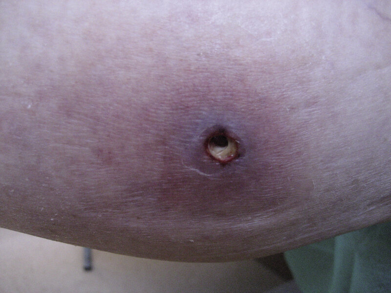 Ryc. 2. Głębokie owrzodzenie w przebiegu Pyoderma gangrenosum.