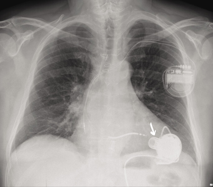 Rycina 3. Zdjęcie RTG P-A chorego z implantowanym systemem HeartWare™ (metalowa kaniula doprowadzająca w koniuszku lewej komory oznaczona strzałką)