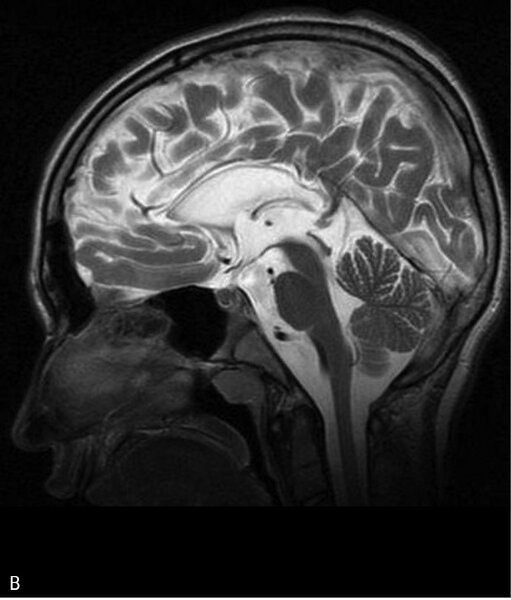 Rycina 3. Leukodystrofia hipomielinizacyjna typu 7 (HLD7) z hipodoncją i hipogonadyzmem hipogonadotropowym. A. MR, sekwencja T2. Hipomielinizacja oraz zmniejszona objętość całej istoty białej półkul mózgu. B. Ścieńczałe ciało modzelowate, widoczny również zanik móżdżku. Chłopiec 10-letni z powoli postępującym zespołem pozapiramidowo-piramidowym i ataksją