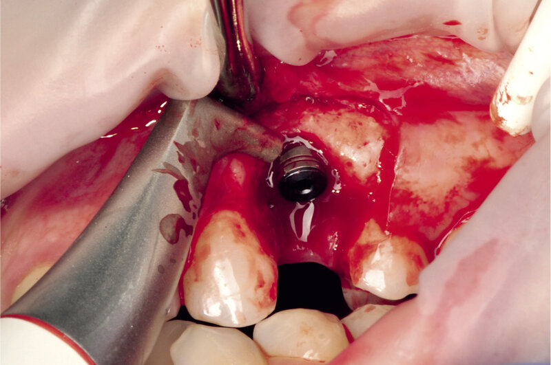 Rycina 6. Oczyszczanie implantu – piaskowanie