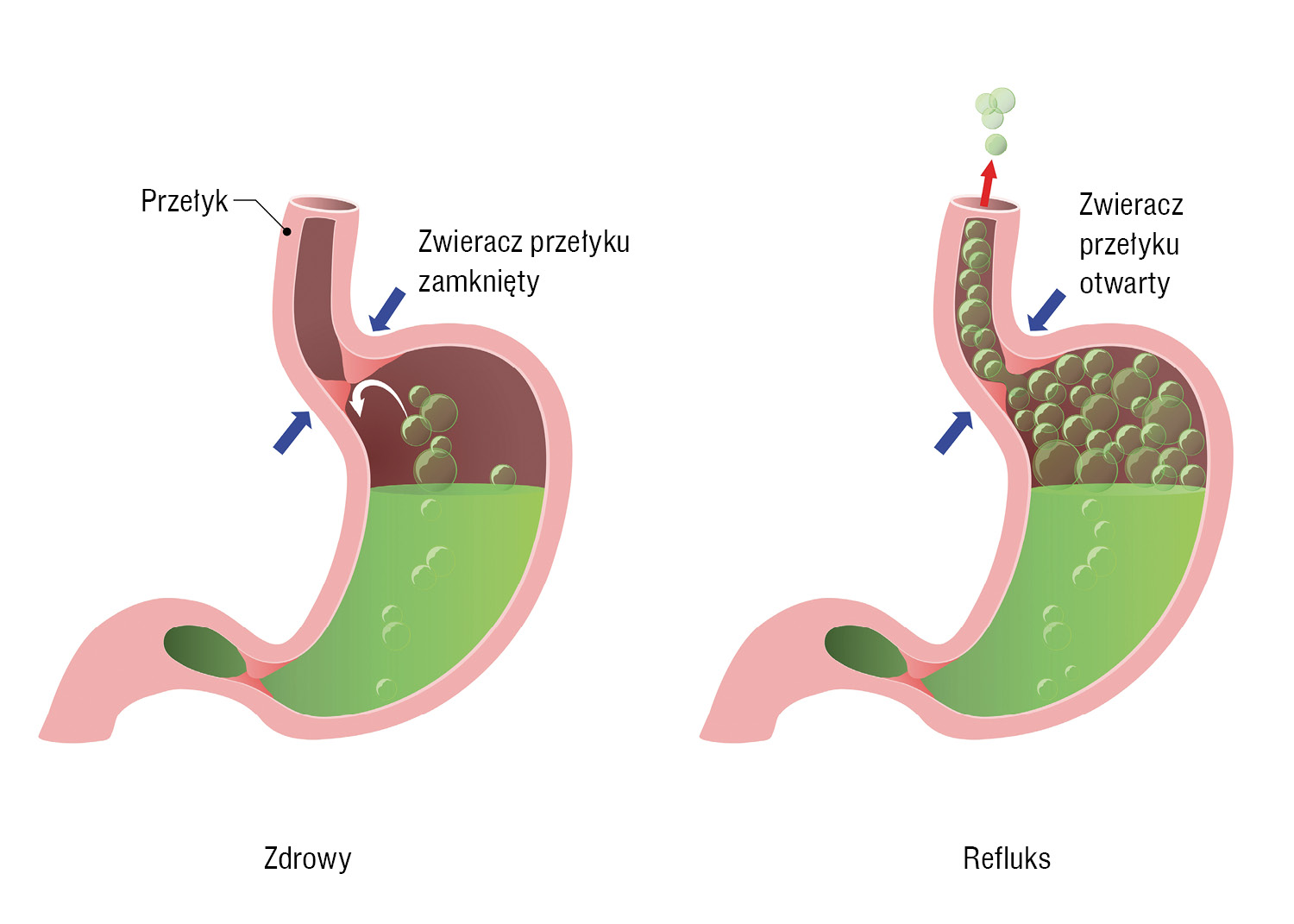 Choroba refluksowa przełyku