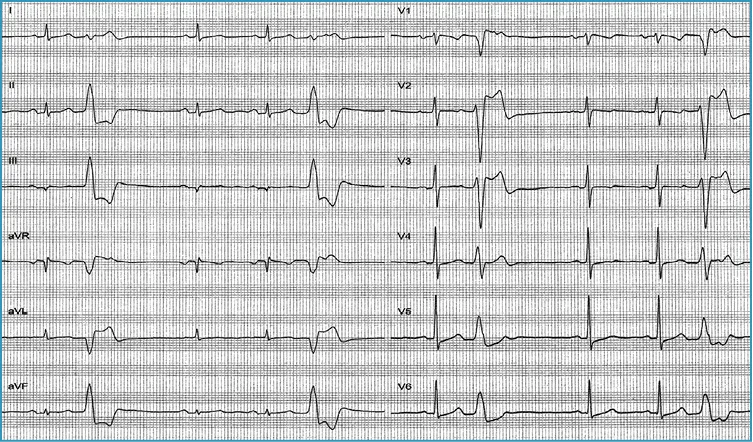 Rycina 4. Rejestracja skurczów dodatkowych komorowych w 12-odprowadzeniowym EKG u chorego bez organicznej choroby serca: morfologia zespołów QRS (wysokie zał. R w odpr. II,III i aVF oraz kształt zespołów QRS zbliżony do bloku lewej odnogi p. Hisa wskazują na drogę odpływu z prawej komory serca jako lokalizację ogniska arytmii. Łagodna forma arytmii komorowej