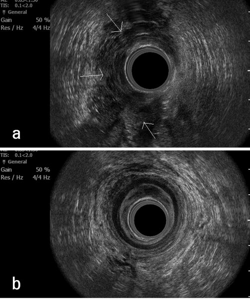 
 
 Fot. 6 Badanie endosonograficzne; guz brzegu odbytu: