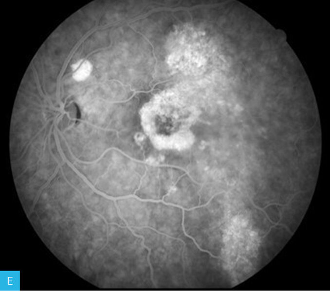 Rycina 7A-F. Angiografia fluoresceinowa dna oka lewego. Obrazy w górnym rzędzie przedstawiają angiogram od fazy tętniczej przez fazę tętniczo-żylną do fazy żylnej