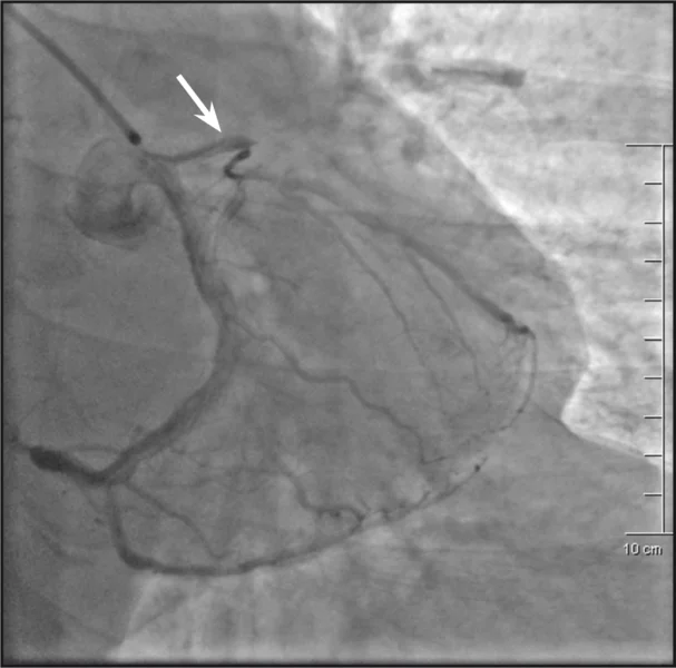 Rycina 1. Angiogram lewej tętnicy wieńcowej – gałąź przednia zstępująca niedrożna w odcinku początkowym (strzałka).