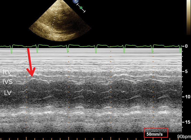 Rycina 16. Zjawisko „septal bounce” (strzał z bicza), czyli wczesnorozkurczowe wygięcie przegrody w kierunku RV zarejestrowane w M-mode z projekcji przymostkowej u pacjenta z zaciskającym zapaleniem osierdzia, wskazane strzałką. Prędkość przesuwu ekranu 50 mm/s (wartość otoczona czerwoną ramką)