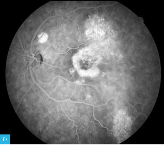 Rycina 7A-F. Angiografia fluoresceinowa dna oka lewego. Obrazy w górnym rzędzie przedstawiają angiogram od fazy tętniczej przez fazę tętniczo-żylną do fazy żylnej
