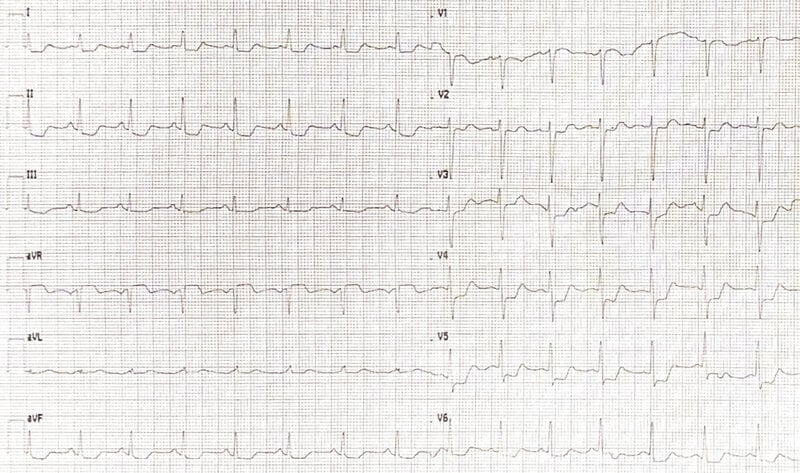 Rycina 1. Zapis elektrokardiograficzny przy przyjęciu. Widoczne obniżenia odcinka ST w odprowadzeniach I, II, III, aVF oraz V3-V6 z uniesieniem odcinka ST w aVR