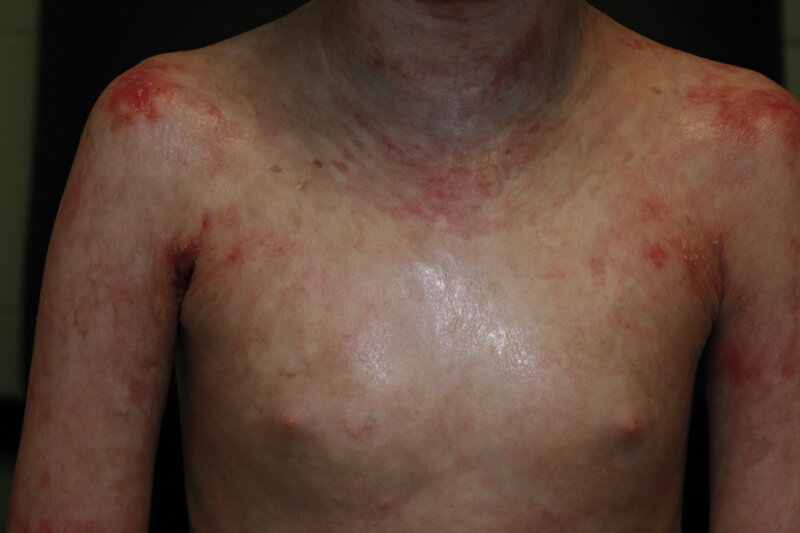 Rycina 11. Erytrodermia u chorego po przeszczepieniu macierzystych komórek krwi obwodowej z powodu SCID.