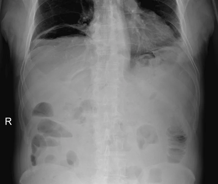 Rycina 5. Perforacja po ECPW – typowy obraz radiologiczny z charakterystycznym sierpem powietrza pod przeponą