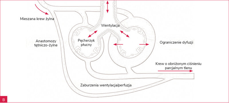 Rycina 1A, B. Mechanizmy prowadzące do hipoksji w zespole wątrobowo-płucnym. A. Prawidłowe krążenie płucne. B. Zespół wątrobowo-płucny