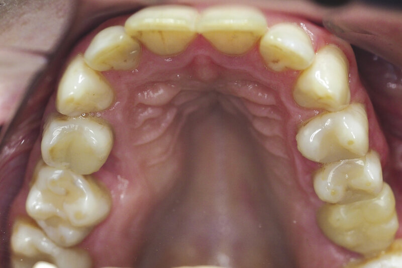 Ryc. 11. Stan po leczeniu endodontycznym i wykonaniu korony kompozytowej.