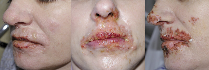 Rycina 1. Herpes labialis. Reaktywacja HSV wzdłuż gałązki 3 nerwu V. Zmiany w kolejnych dniach.
