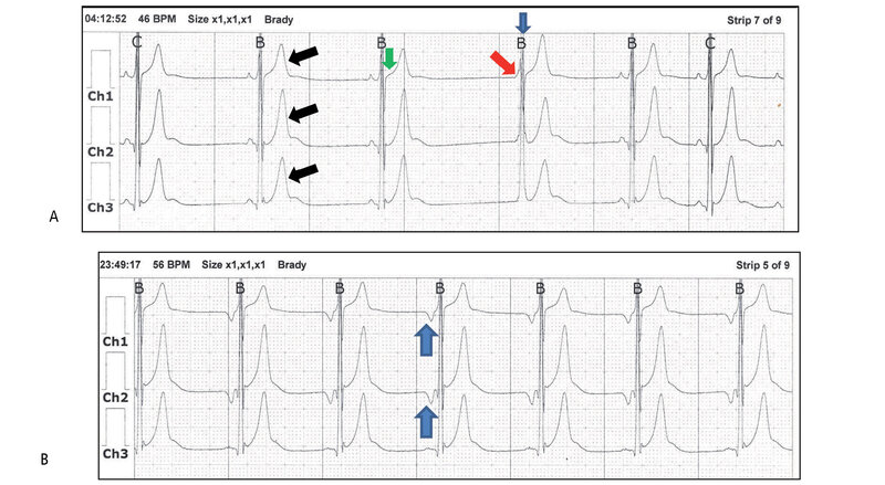 Rycina 7. (A) Zapis holterowski EKG (3-kanałowy, Ch1 – zmodyfikowane komputerowo odprowadzenie przedsercowe V5, Ch2 – zmodyfikowane komputerowo odprowadzenie przedsercowe V1) u pacjenta z ryciny 6, w godzinach nocnych (godz. 04:12:52) zastępcze pobudzenie węzłowe (strzałka niebieska wskazuje czwarty w kolejności wąski węzłowy zespół QRS; strzałka czerwona wskazuje na zachodzenie na siebie dodatniego zatokowego załamka P i wąskiego zespołu QRS pobudzenia węzłowego). Pierwsze trzy i ostatnie dwa zespoły maja charakter rytmu zatokowego (dodatnie załamki P poprzedzające zespoły QRS), cechy wagotonii – wysoka amplituda załamków T we wszystkich 3 kanałach (czarne strzałki), ponadto w kanale pierwszym (Ch1 – odprowadzenie V5) dyskretne uniesienie odcinka ST; zielona strzałka). Przesuw papieru 25 mm/s. (B) Zapis holterowski EKG (3-kanałowy, ChH1 – zmodyfikowane komputerowo odprowadzenie przedsercowe V5, Ch2 – zmodyfikowane komputerowo odprowadzenie przedsercowe V1) u pacjenta z ryciny 6, w godzinach nocnych rytm przedsionkowy z ujemnymi załamkami P (strzałki – kanał Ch1 i Ch2) o częstości 56/min. Przesuw papieru 25 mm/s.