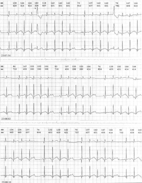 Rycina 1. Fragmenty trzykanałowego holterowskiego zapisu EKG (przesuw papieru 25 mm/s) 4-miesięcznego chłopca z prawidłową anatomią serca. Pobudzenia dodatkowe nadkomorowe nieprzewodzone blokują węzeł zatokowo-przesionkowy, wydłużając odstępy RR