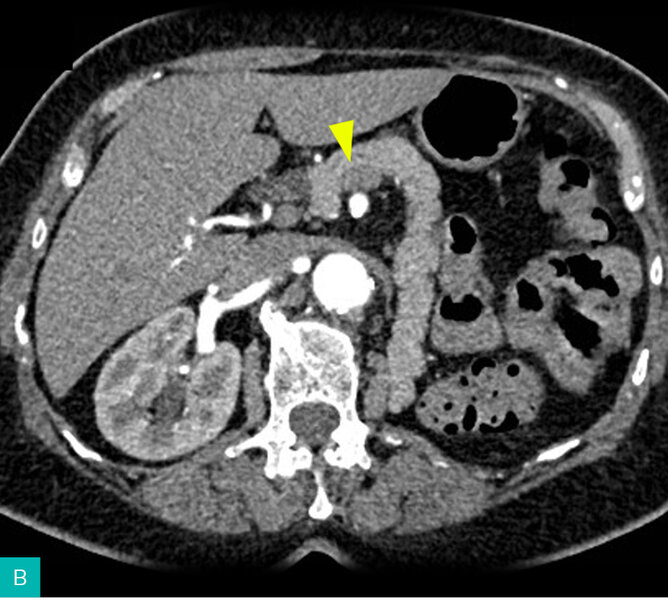 Rycina 4A-B. A. Endosonograficzna ocena guza neuroendokrynnego 3 miesiące po ablacji RFA pod kontrolą EUS z widocznym brakiem przepływu w obrazowaniu DFI. B. Potwierdzenie skuteczności leczenia w TK – zmiana bez wzmocnienia kontrastowego