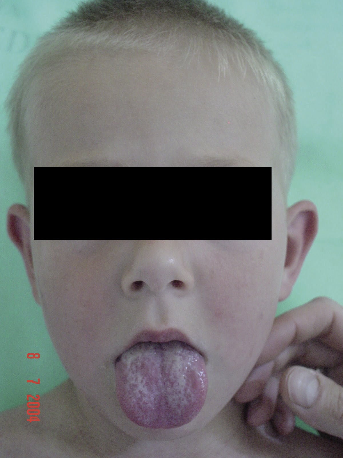 Rycina 2. Rumień twarzy, charakterystyczna bladość wokół ust oraz nalot na języku we wczesnej fazie szkarlatyny.