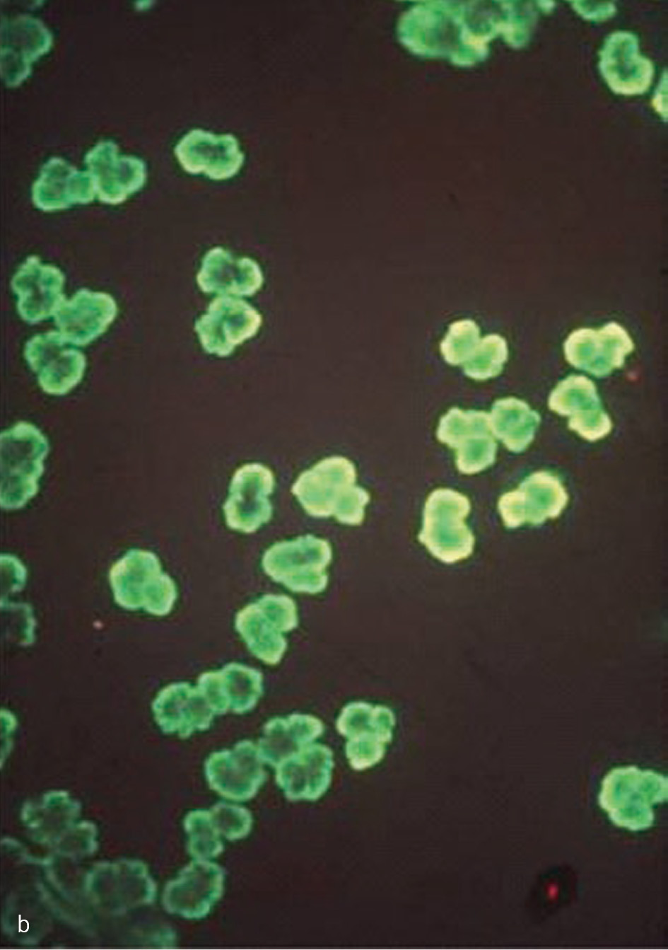 Rycina 1. Identyfikacja przeciwciał przeciwko cytoplazmie neutrofilów (ANCA) metodą immunofluorescencji pośredniej. (a) ANCA typ cytoplazmatyczny: dodatnie znakowanie w cytoplazmie neutrofilów z obecnością ziarnistości i immunofluorescencją pomiędzy segmentami jąder komórkowych. (b) ANCA typ okołojądrowy: immunofluorescencja widoczna wokół jąder neutrofilów.