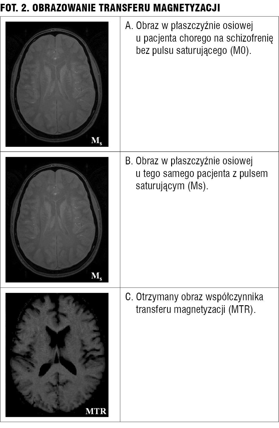 Użyteczność tomografii komputerowej i rezonansu magnetycznego w psychiatrii