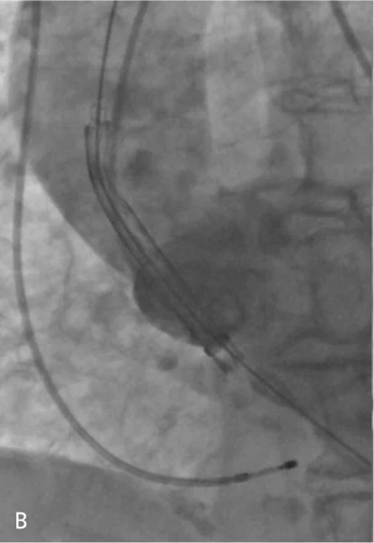 Rycina 3. Kolejne etapy implantacji zastawki CoreValve™.