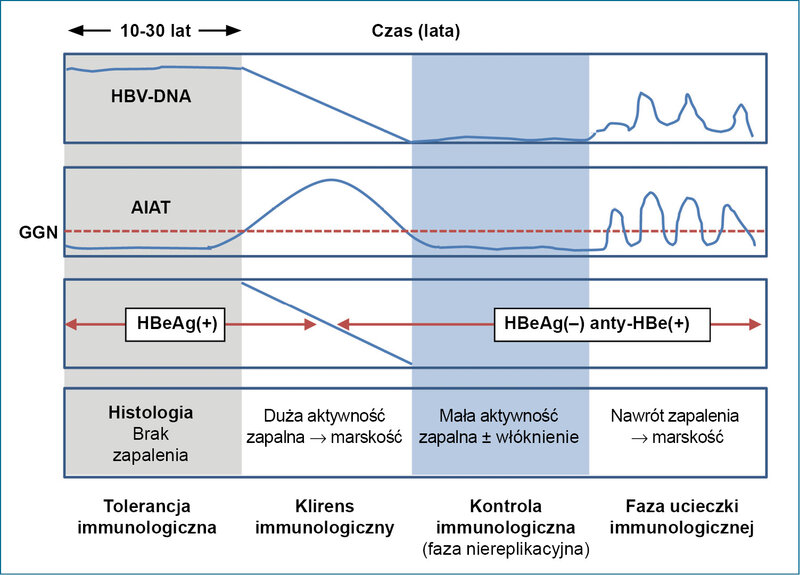 Rycina 1. Schemat historii naturalnej zakażenia HBV. Ryzyko postępującego włóknienia i marskości wątroby istnieje wyłącznie w fazie aktywności i ucieczki immunologicznej. Tylko w tych fazach należy chorego kwalifikować do leczenia przeciwwirusowego. 