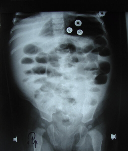 Rycina 2. Zdjęcie przeglądowe jamy brzusznej w pozycji pionowej u dziecka z wgłobieniem jelitowym. Widoczne radiologiczne cechy niedrożności przewodu pokarmowego – liczne poziomy płynów w zakresie jelita cienkiego.