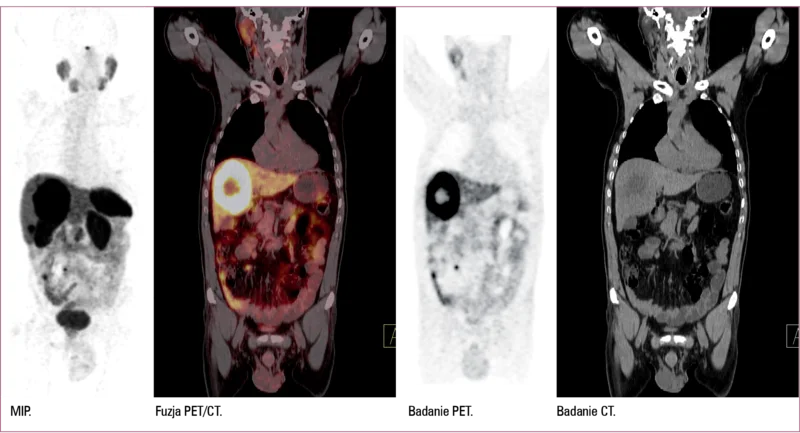 
 
 
 
 Badanie PET/CT po podaniu 68Ga-DOTATATE w kierunku obecności receptorów somatostatynowych i poszukiwania zmiany pierwotnej  u pacjenta z przerzutami do wątroby. W badaniu widoczna jest zmiana pierwotna zlokalizowana w jelicie krętym wraz z przerzutami do węzła chłonnego krezki i do wątroby.