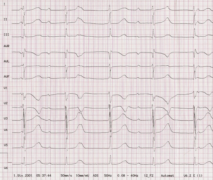 Rycina 5. Zapis EKG 12-odprowadzeniowy (przesuw papieru 50 mm/s) 6-letniego chłopca z prawidłową anatomią serca i wrodzonym blokiem przedsionkowo-komorowym, bez objawów bradykardii. Rytm przedsionków 100/min, komór 65/min, zespoły QRS=80 ms, normogram, odstęp QTc 440-460 ms, dyskretne zaburzenia przewodzenia śródkomorowego
