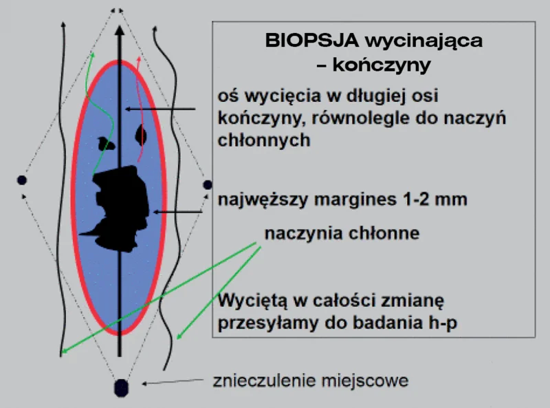 Ryc. 1. Prawidłowy kierunek cięcia przy wykonywaniu biopsji wycinającej.