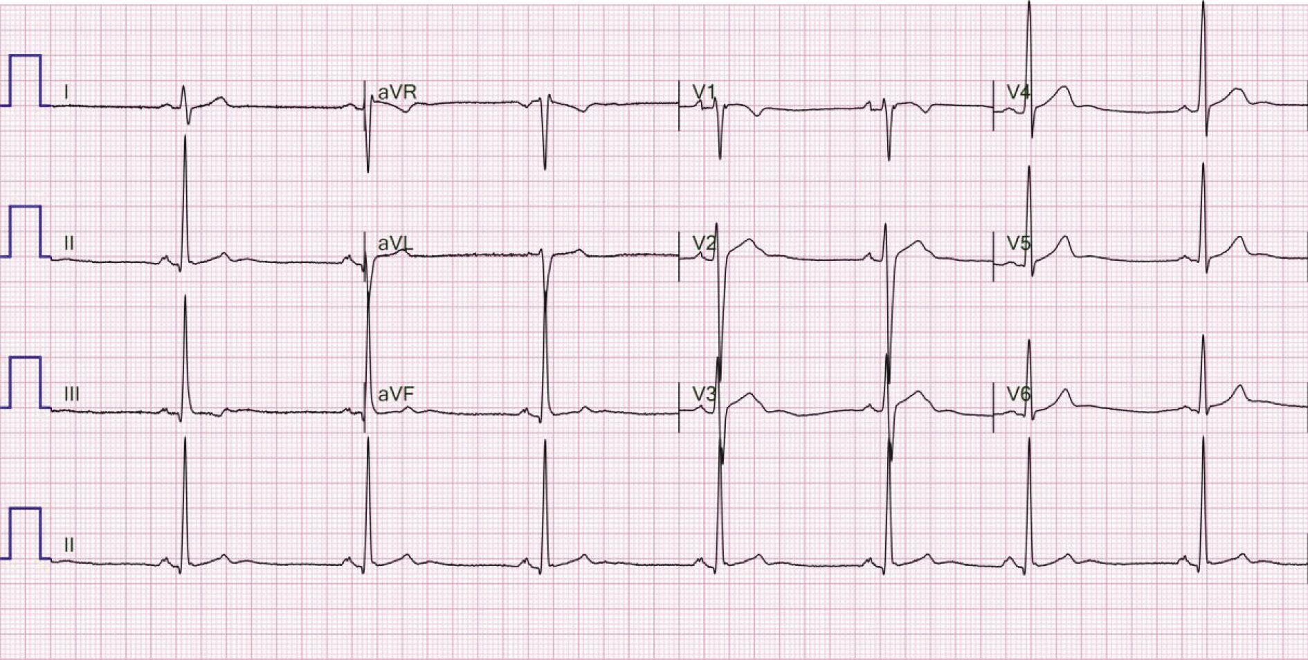 Rycina 1. Zapis 12-kanałowego EKG 36-letniego sportowca ze zdiagnozowaną arytmogenną kardiomiopatią prawokomorową, u którego w rezonansie magnetycznym serca stwierdzono regionalne zaburzenia kurczliwości prawej komory. W zapisie widoczne TAD (terminal activation delay) 63 ms w odprowadzeniach V1 i V2