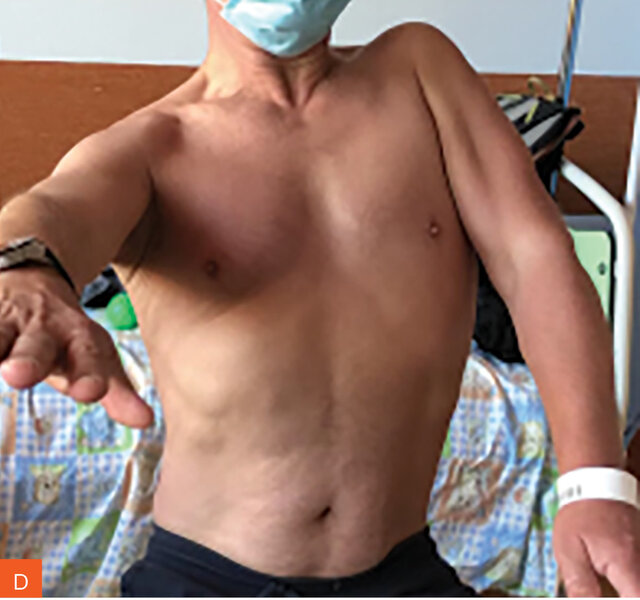 Rycina 5A-F. Jednostronne zaniki mięśniowe. A-D. Stan po miesiącu od ostrej fazy choroby. E, F. Stan po roku i wielomiesięcznej rehabilitacji porażenia czterokończynowego