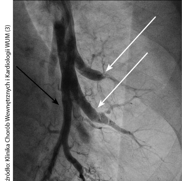 Ryc. 1. Obraz angiograficzny przewlekłych zmian zatorowo-zakrzepowych (przepony, zwężenia, niedrożność) u pacjentki z nadciśnieniem płucnym (CTEPH) – (białe strzałki). Angiografia selektywna po skutecznej angioplastyce balonowej tętnicy dolnopłatowej lewej (czarna strzałka).