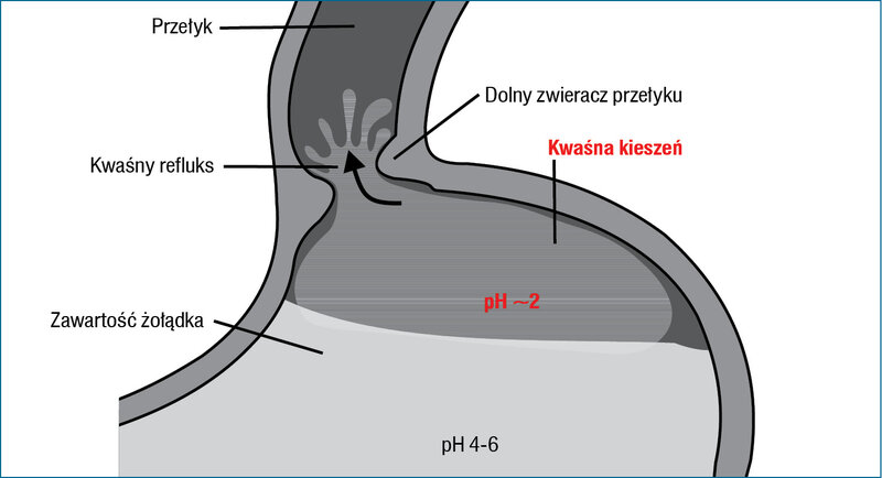 Rycina 1. Poposiłkowa kwaśna kieszeń (na podstawie 4 pozycji piśmiennictwa) 