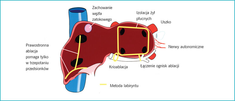  Rycina 11. Migotanie przedsionków: czego można się nauczyć od chirurgów. Stosowane obecnie przezskórne, wewnątrznaczyniowe techniki ablacji w dużej mierze rozwinęły się dzięki doświadczeniom kardiochirurgów w leczeniu migotania przedsionków. Izolacja żył płucnych, linearne ablacje, zrozumienie roli zamknięcia uszka lewego przedsionka lub modyfiakcja unerwienia autonomicznego – to doświadczenia, które zawdzięczamy pracy chirurgów.