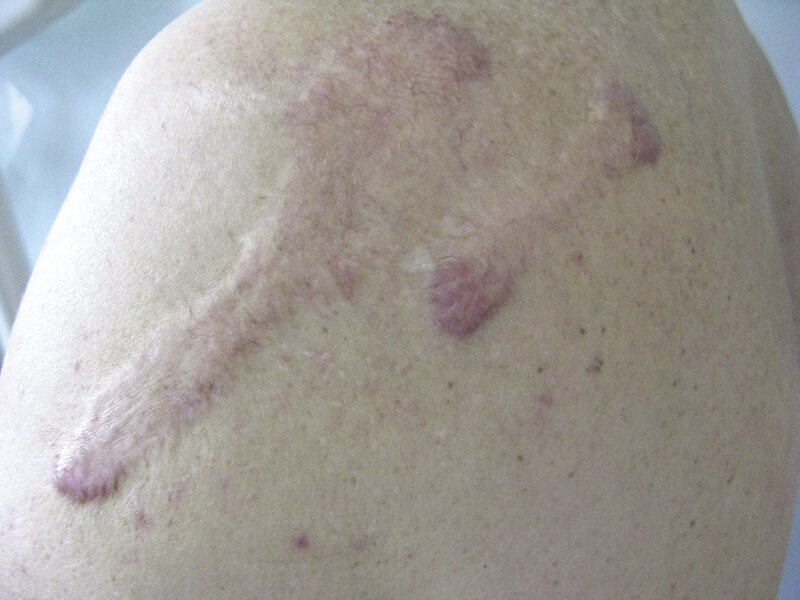 Rycina 4. Keloid po szczepieniu.