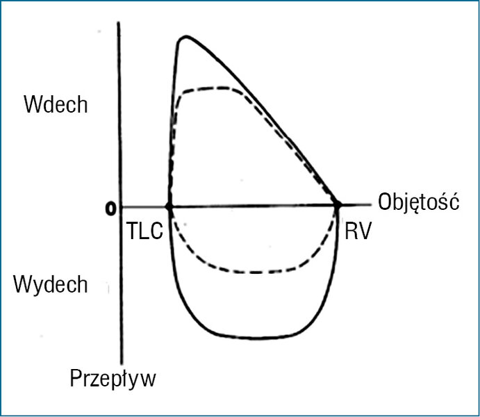Rycina 3. Krzywa przepływ-objętość u osoby zdrowej (linia ciągła) i osoby z obturacją górnych dróg oddechowych (linia przerywana). 