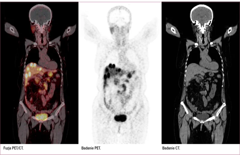
 
 
 
 Badanie PET/CT w kierunku obecności receptorów somatostatynowych po podaniu 68Ga-DOTATATE u pacjentki po leczeniu operacyjnym raka  neuroendokrynnego trzustki. W badaniu widoczne są liczne rozsiane ogniska o zwiększonej ekspresji receptorowej w wątrobie.