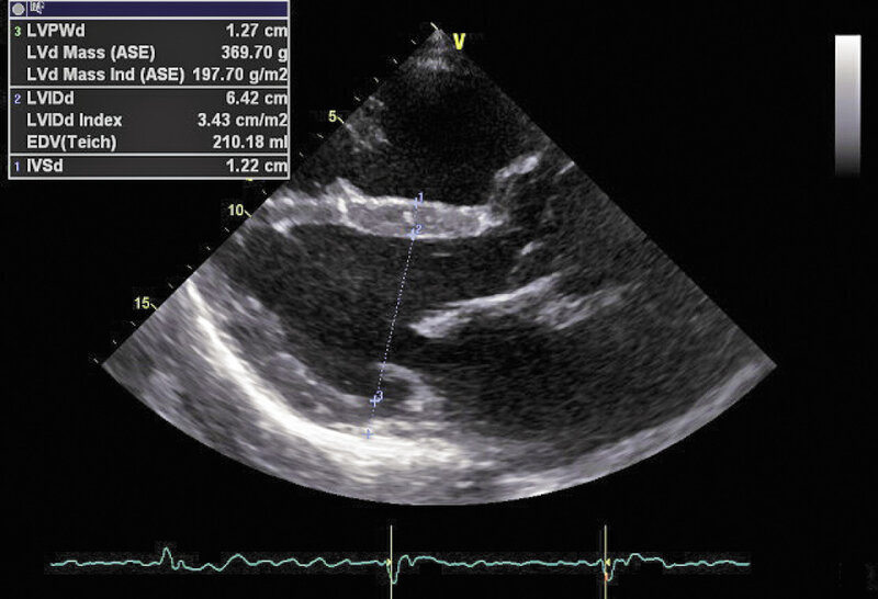 Rycina 1. Obrazowanie 2D. Projekcja przymostkowa w osi długiej.
