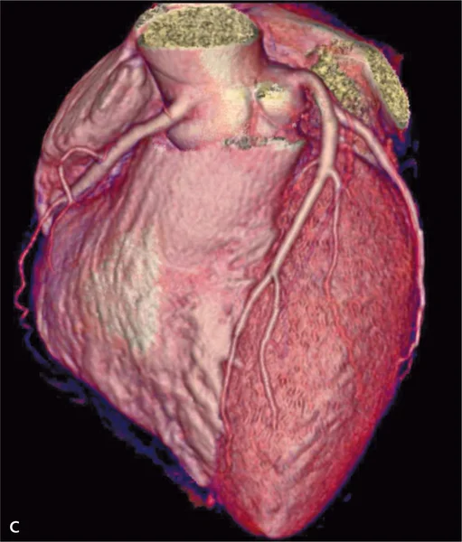 RYCINA 1. Angiografia TK (rekonstrukcje VR [A] i MIP [B]) tętnic obwodowych, angiografia TK (rekonstrukcja VR) serca i tętnic wieńcowych [C] oraz angiografia TK aorty (warstwa poprzeczna na poziomie tętniaka aorty brzusznej) [D] u pacjenta z podejrzeniem choroby wieńcowej. Badanie uwidoczniło prawidłowy obraz tętnic wieńcowych, rozwarstwienie w tętniaku aorty brzusznej, obecność podwójnych tętnic nerkowych, krytyczne zwężenie lewej tętnicy biodrowej wspólnej (Kardiol Dypl 2006; 5 (4): 97-100).