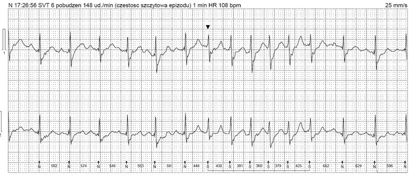 Rycina 2. Wstawka częstoskurczu przedsionkowego 6 QRS o częstości 148/min. Znacznik pokazuje pierwsze pobudzenie częstoskurczu, wyraźnie wyższe załamki T w kolejnych pobudzeniach – najpewniej z załamkami P’