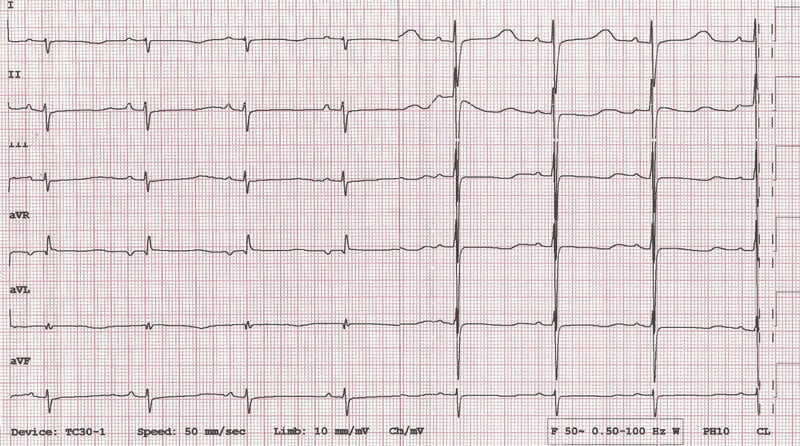 Rycina 3. Zapis EKG 12-odprowadzeniowy (przesuw papieru 50 mm/s) noworodka z zespołem Fallota w 8 dobie życia. Rytm zatokowy około 100/min, odstęp PR=100 ms, prawogram, zaznaczona prawa komora, w większości odprowadzeń płaskie załamki T, wydłużony odstęp QTc do 500 ms