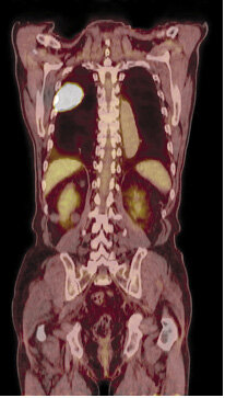 Ryc. 2. Badanie PET-CT po podaniu 18FDG. Rak płuca.
