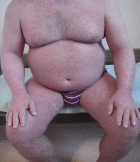 Ryc. 2. Pięćdziesięcioletni chory z erytrodermią łuszczycową i otyłością (BMI, body mass index > 30).