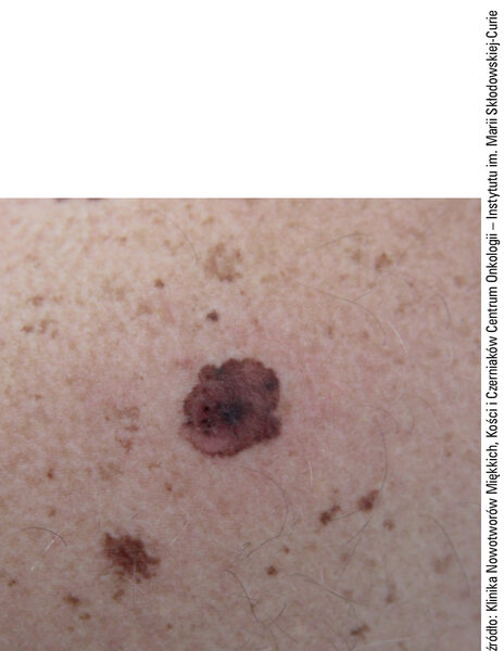 
 
 
 
 Fot. 2. Czerniak szerzący się powierzchownie (Superficial spreading melanoma). Zmiana wykazuje niejednolite zabarwienie i nieregularne zarysy.